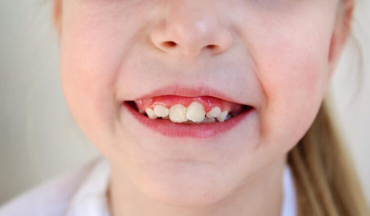 What Happens If You Leave Crooked Teeth Untreated?