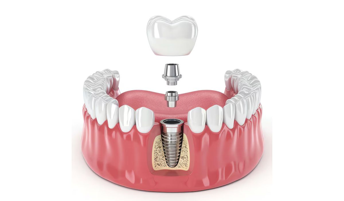 Dental Implant in Simi Valley