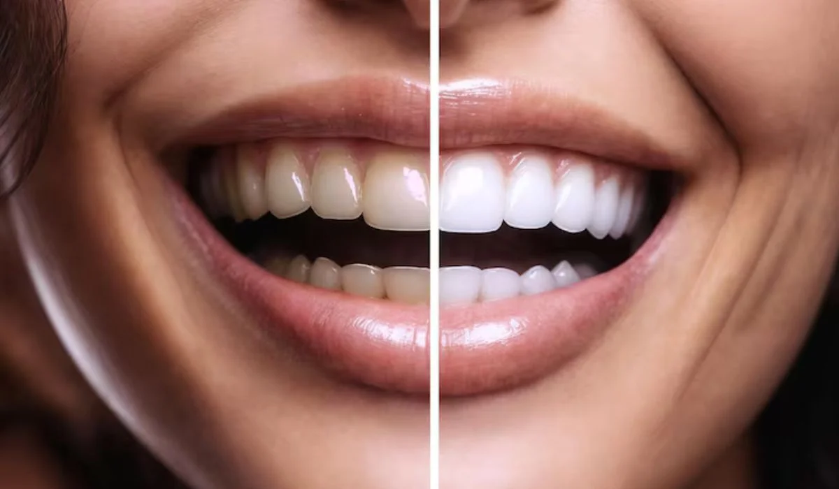 dental cleaning