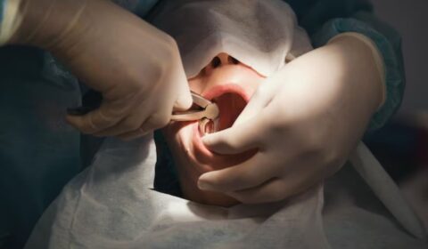 tooth extraction
